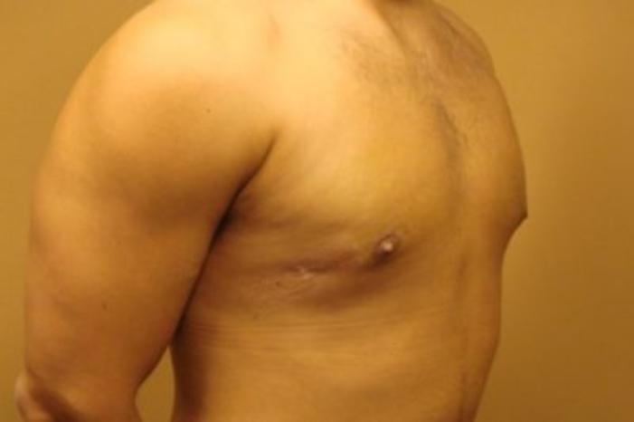 Case #2075 – Gynecomastia
