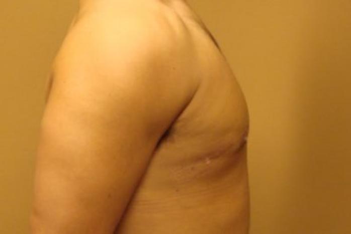 Case #2075 – Gynecomastia