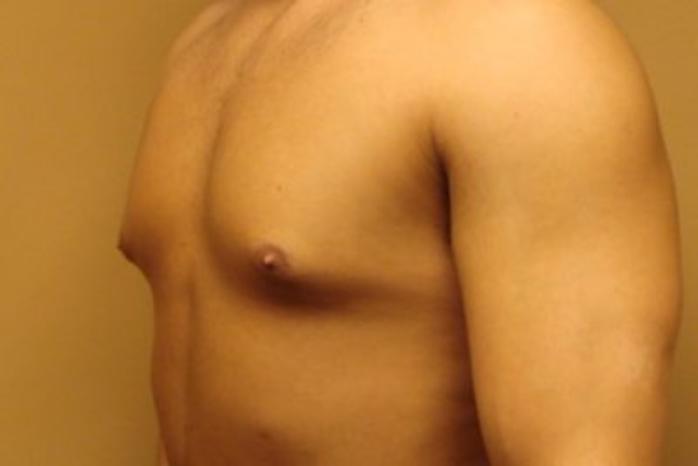 Case #2075 – Gynecomastia