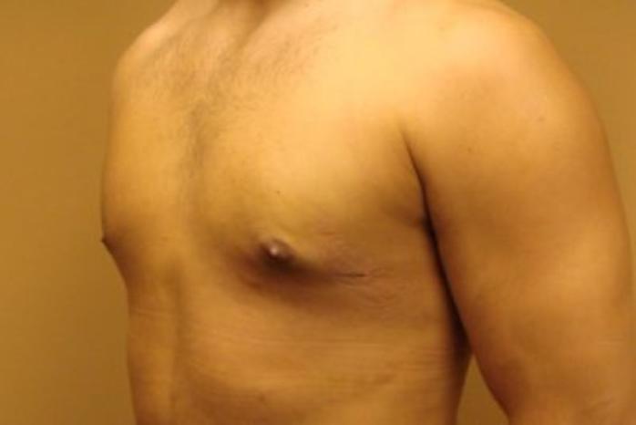 Case #2075 – Gynecomastia