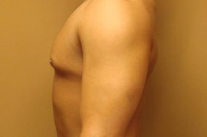 Case #2075 – Gynecomastia