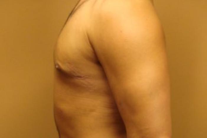 Case #2075 – Gynecomastia