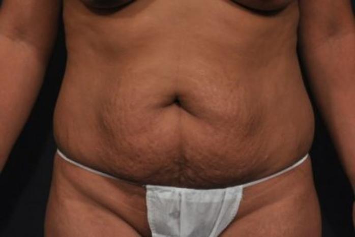 Case #212 – Tummy Tuck