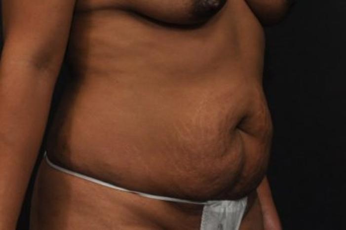 Case #212 – Tummy Tuck