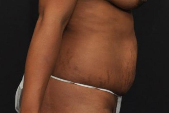 Case #212 – Tummy Tuck