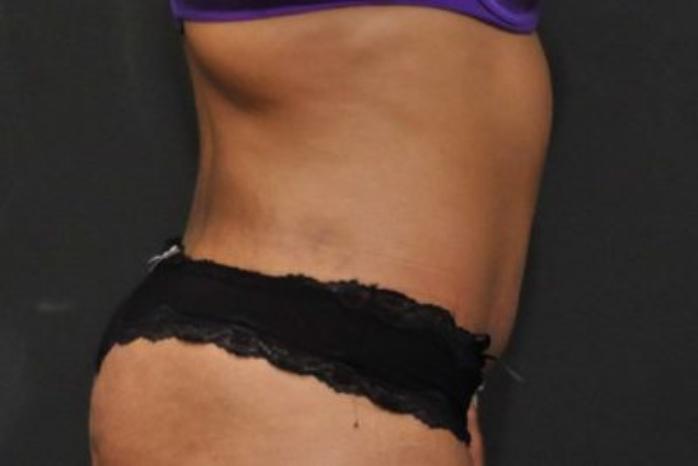 Case #212 – Tummy Tuck