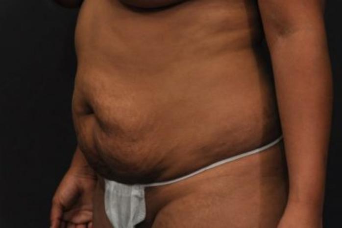Case #212 – Tummy Tuck