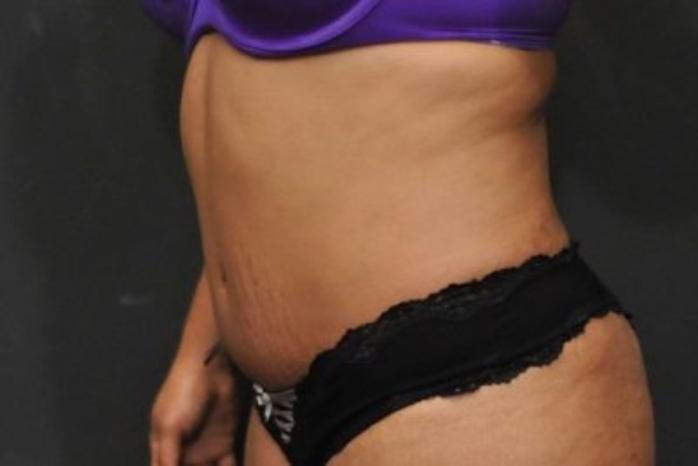 Case #212 – Tummy Tuck