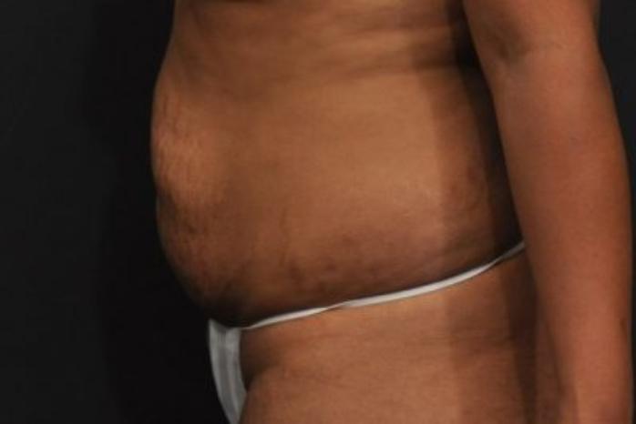 Case #212 – Tummy Tuck