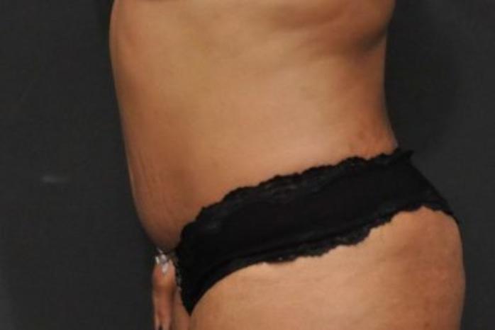 Case #212 – Tummy Tuck