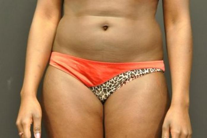 Case #2163 – Body Contouring