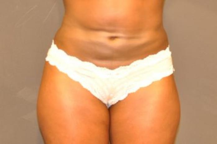 Case #2163 – Body Contouring