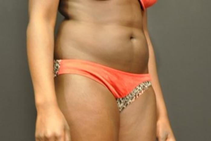 Case #2163 – Body Contouring