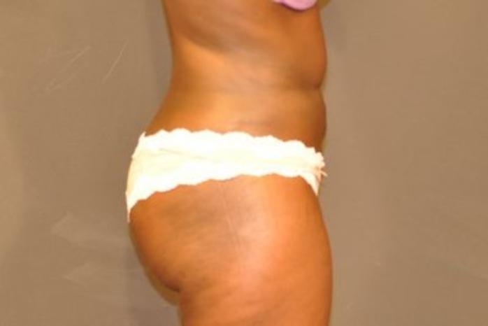 Case #2163 – Body Contouring