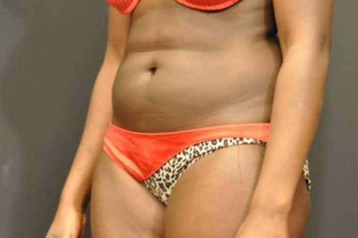 Case #2163 – Body Contouring