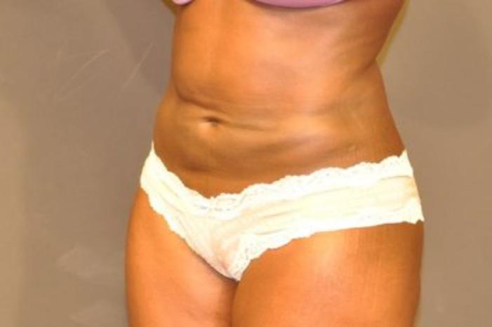 Case #2163 – Body Contouring
