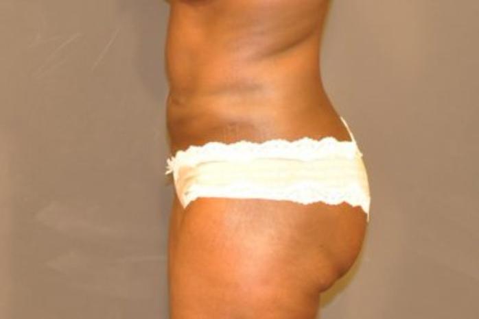 Case #2163 – Body Contouring