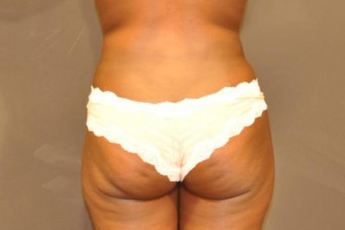 Case #2163 – Body Contouring