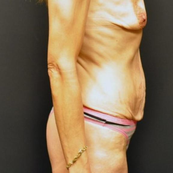 Case #224 – Tummy Tuck
