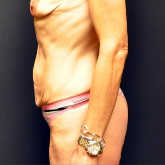 Case #224 – Tummy Tuck