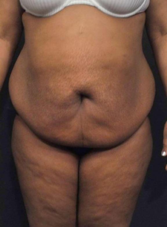 Case #236 – Liposuction