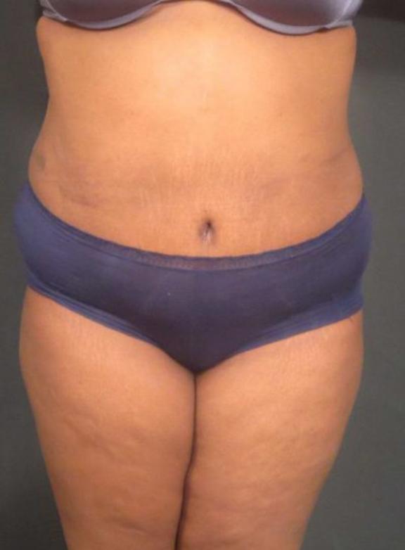 Case #236 – Liposuction