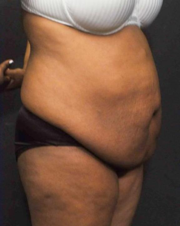Case #236 – Liposuction