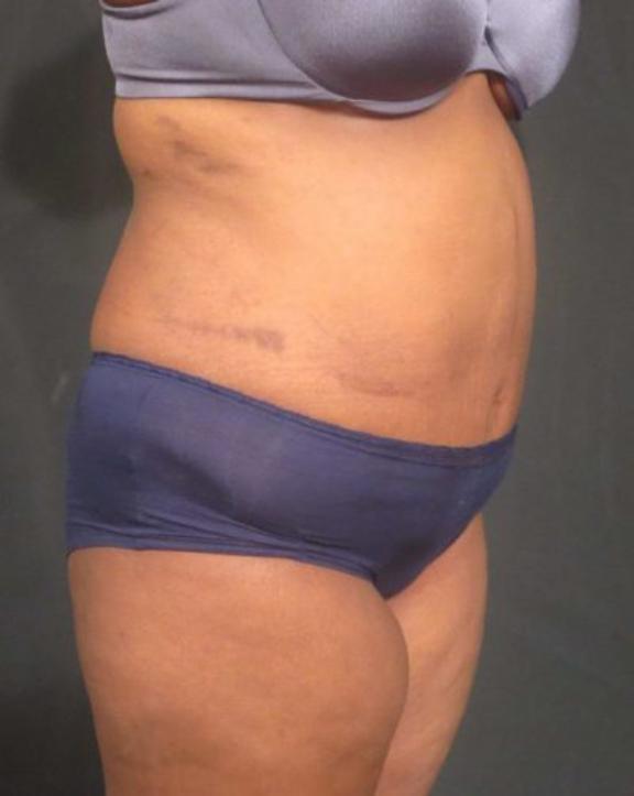 Case #236 – Liposuction