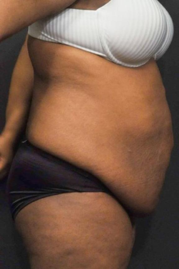 Case #236 – Liposuction