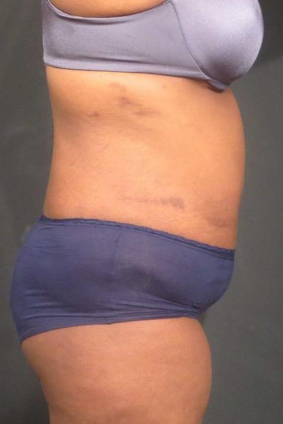 Case #236 – Liposuction