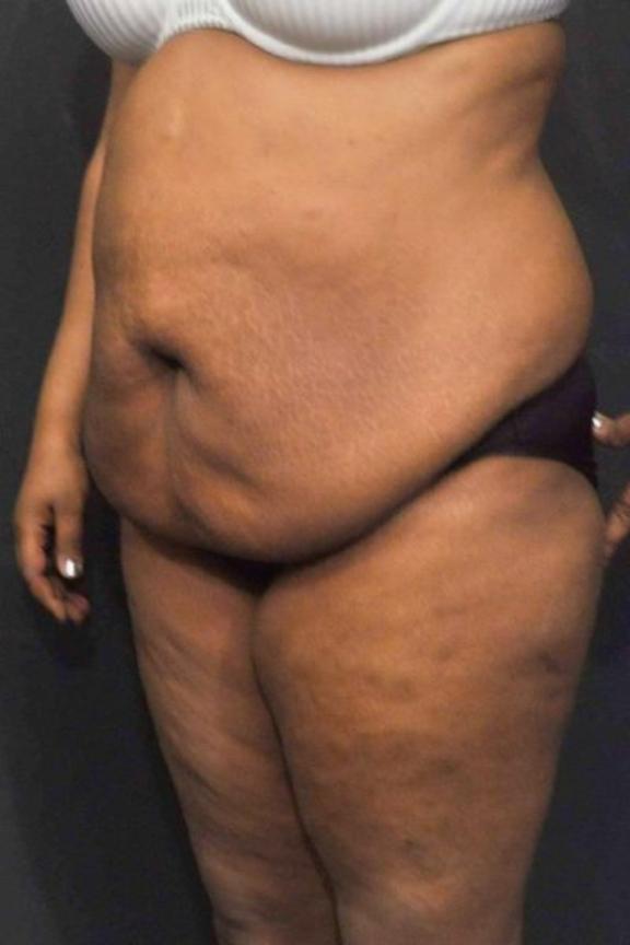 Case #236 – Liposuction