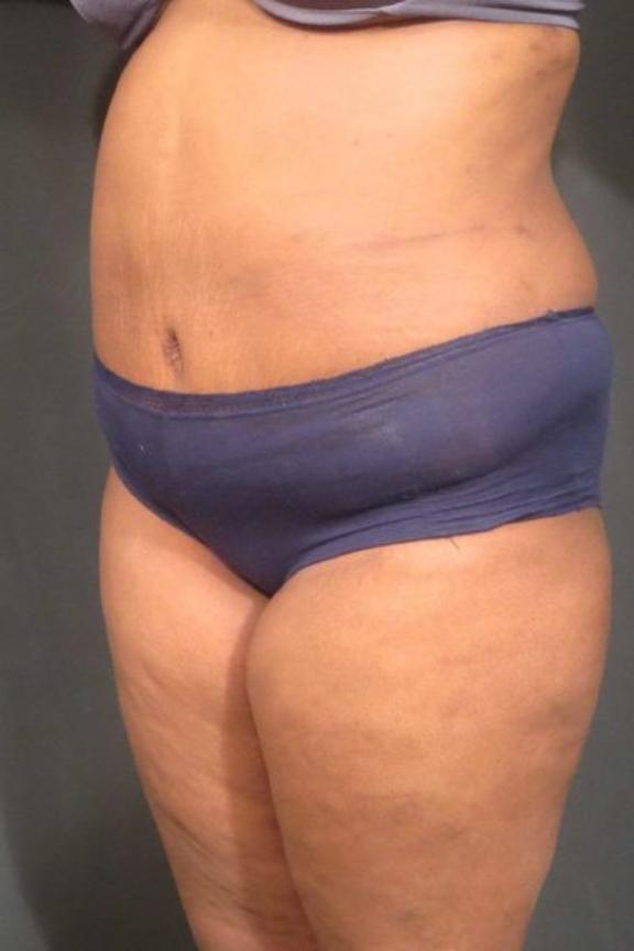 Case #236 – Liposuction