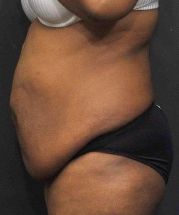 Case #236 – Liposuction