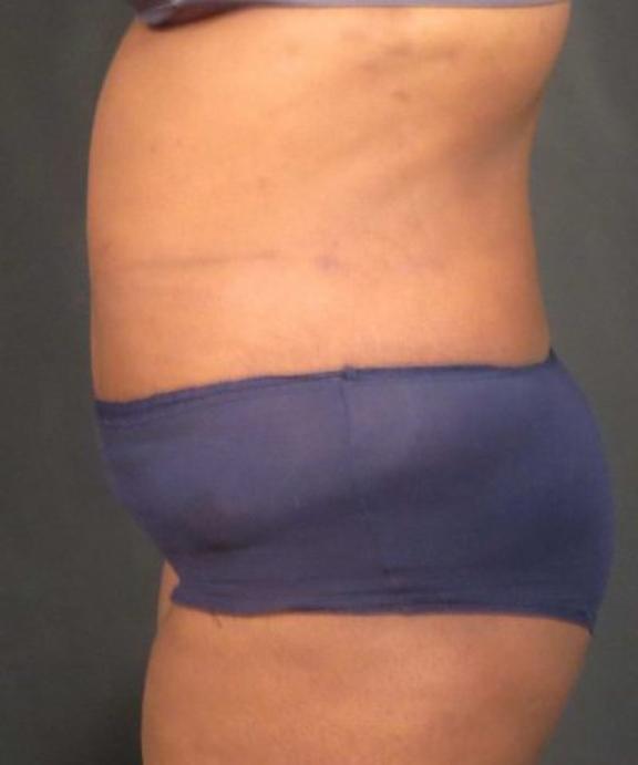 Case #236 – Liposuction