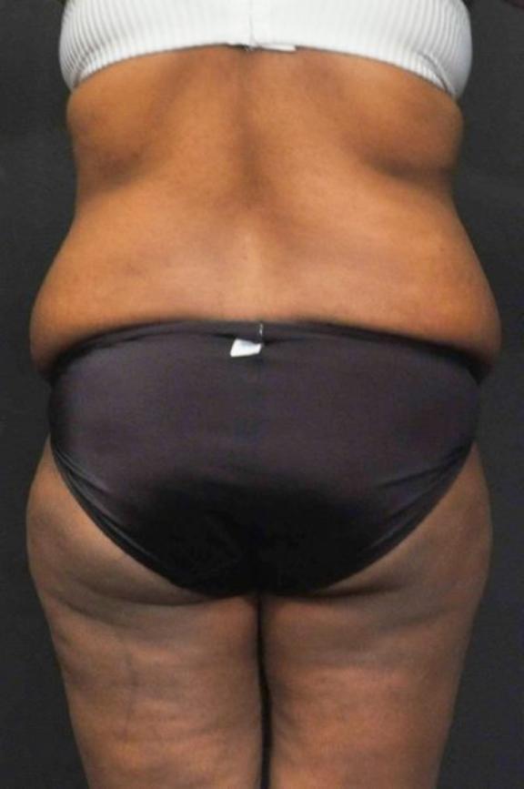 Case #236 – Liposuction
