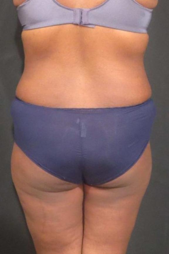 Case #236 – Liposuction
