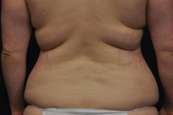 Case #272 – Lower Body Lift
