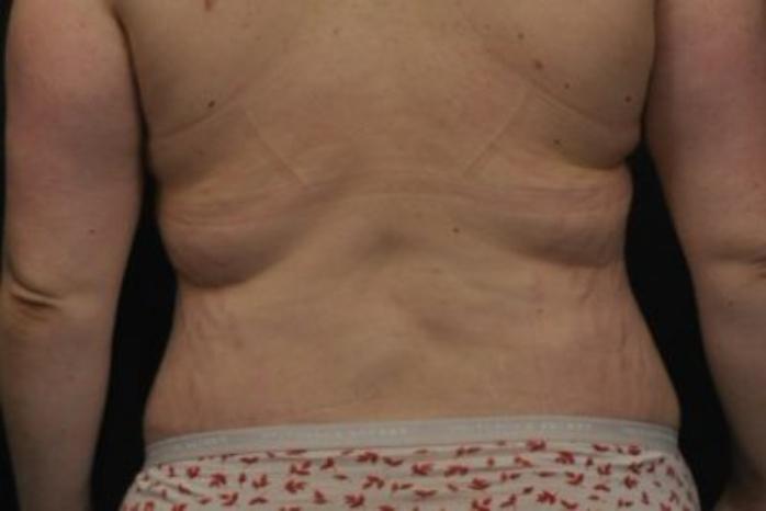 Case #272 – Lower Body Lift