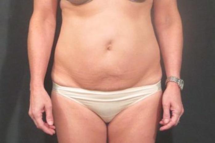 Case #310 – Tummy Tuck