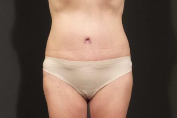 Case #310 – Tummy Tuck