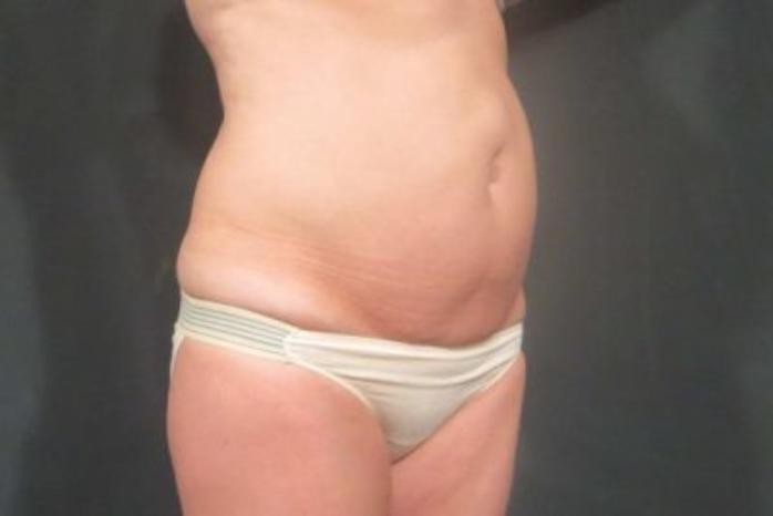 Case #310 – Tummy Tuck