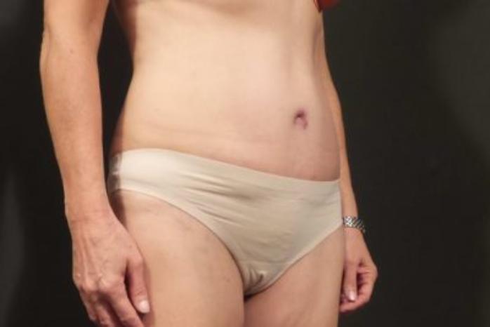 Case #310 – Tummy Tuck