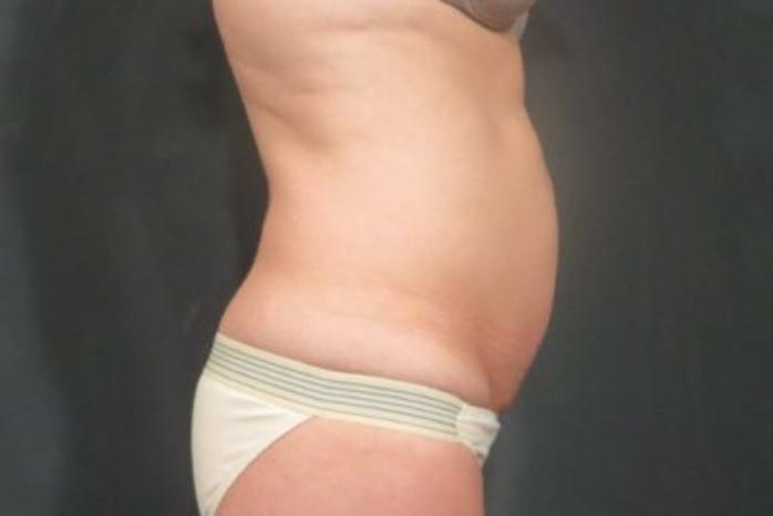 Case #310 – Tummy Tuck