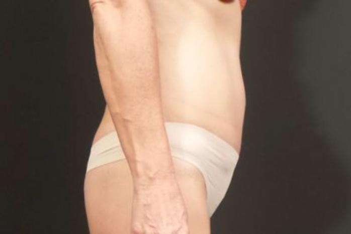Case #310 – Tummy Tuck