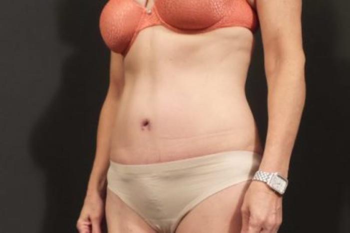 Case #310 – Tummy Tuck