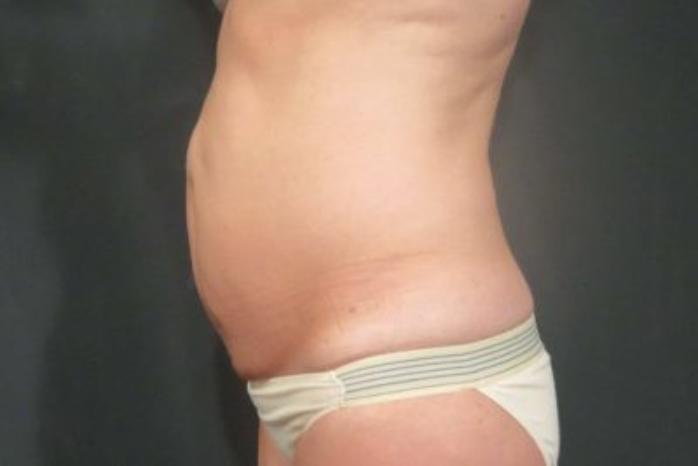 Case #310 – Tummy Tuck