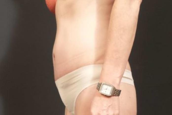 Case #310 – Tummy Tuck