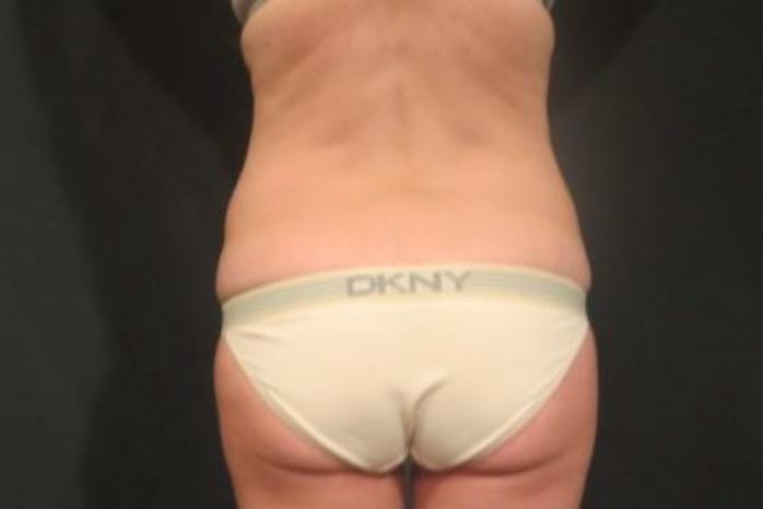 Case #310 – Tummy Tuck