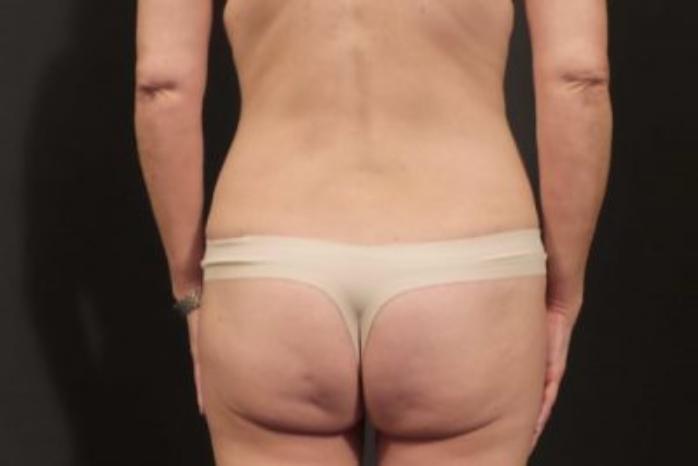 Case #310 – Tummy Tuck