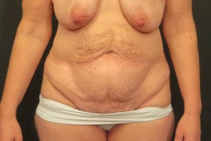Case #324 – Tummy Tuck
